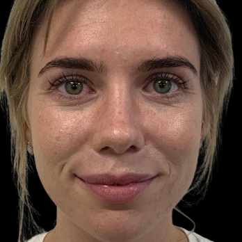 Ultrasonic-rhinoplasty-after